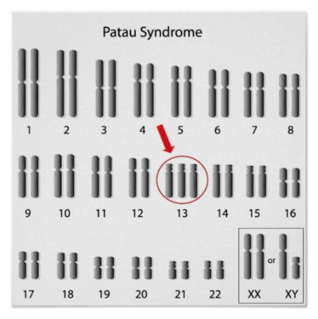 xét nghiệm Karyotype phát hiện hội chứng Patau