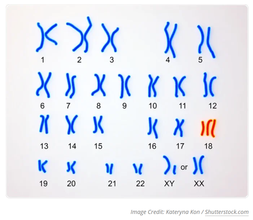 xét nghiệm Karyotype phát hiện hội chứng edwards