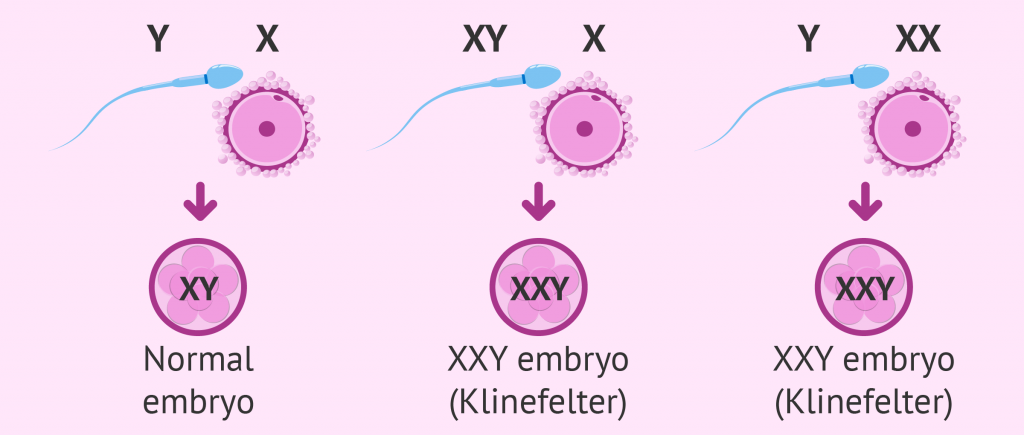 nguyên nhân gây ra hội chứng Klinefelter